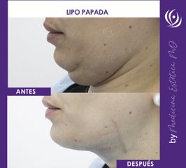 Lipo papada - Medicina Estética Integral MD