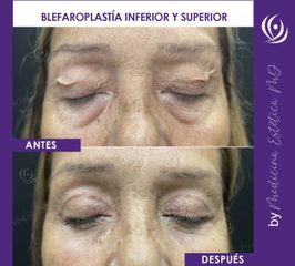 Blefaroplastia - Medicina Estética Integral MD