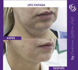 Lipo papada - Medicina Estética Integral MD