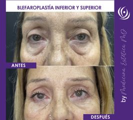 Blefaroplastia - Medicina Estética Integral MD