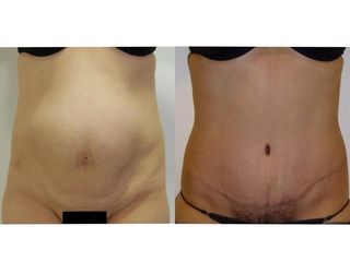 ABDOMINOPLASTIA