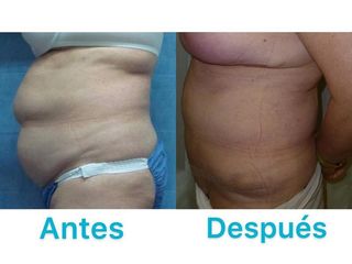 ABDOMINOPLASTIA
