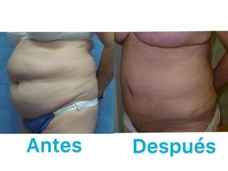 ABDOMINOPLASTIA