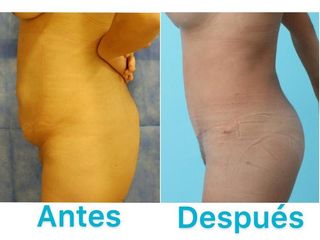 ABDOMINOPLASTIA