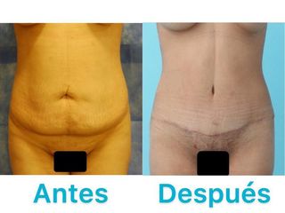 ABDOMINOPLASTIA
