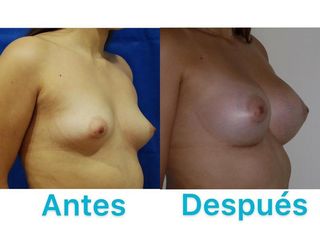 AUMENTO MAMARIO
