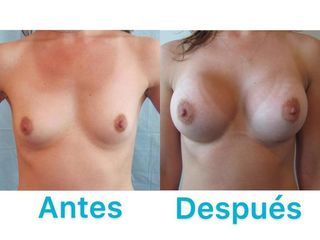 AUMENTO MAMARIO