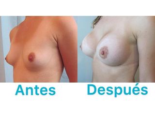 AUMENTO MAMARIO