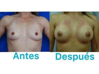 AUMENTO MAMARIO