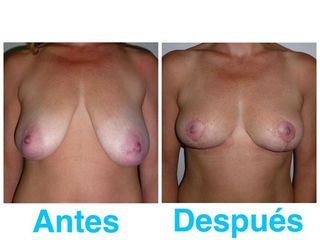 PEXIA MAMARIA SIN IMPLANTES