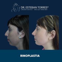 Rinoplastia - Dr. Esteban Torres Egaña