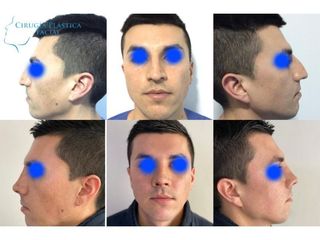 Rinoplastia - Dr. Rodrigo Pinto Carcamo