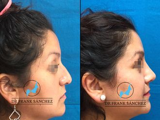 Rinoplastia - 619591
