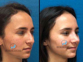 Rinoplastia - 623498