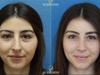 Rinoplastia - 632120