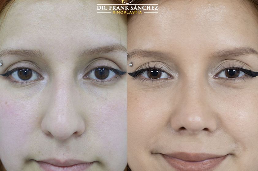 Rinomodelación antes y después - 787536