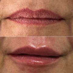 Aumento labios - Dra. Karina Flores Rojas