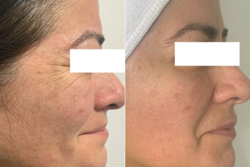 Plasma rico en plaquetas antes y después - 865148