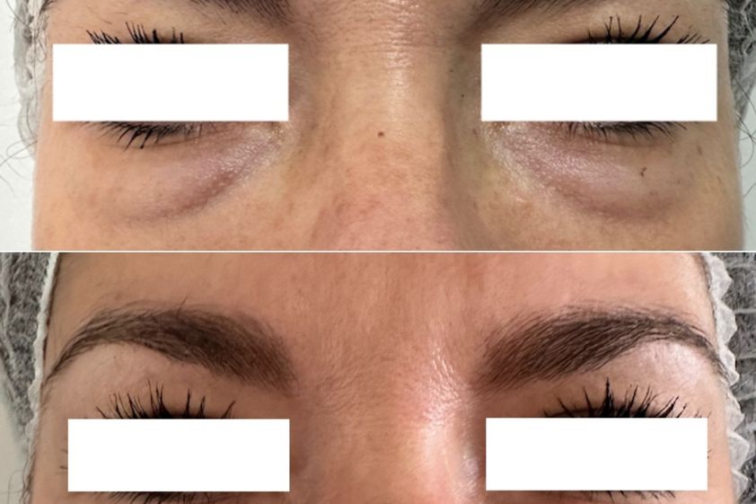 Tratamiento de bolsas en los ojos antes y después - 865150