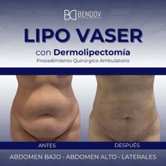 Lipo Vaser con Dermolipectomia - Clinica Bendov