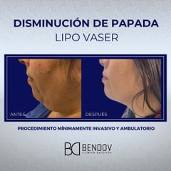 LipoVaser Disminución de Papada - Clinica Bendov