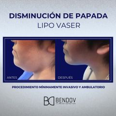 Lipo Vaser Disminución de Papada - Clinica Bendov