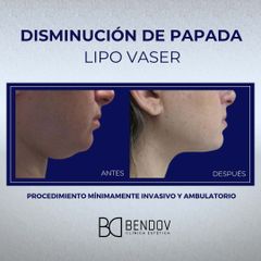 Lipo Vaser Disminución de Papada - Clinica Bendov