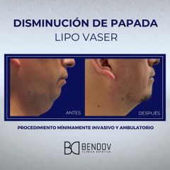 Lipo Vaser Disminución de Papada - Clinica Bendov