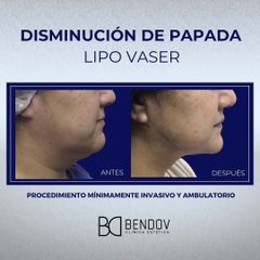 Lipo Vaser Disminución de Papada - Clinica Bendov