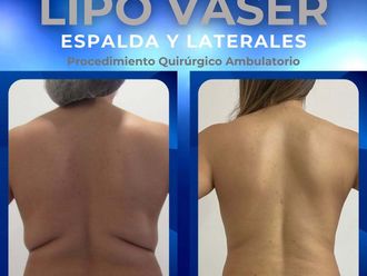 Liposucción antes y después - 872302