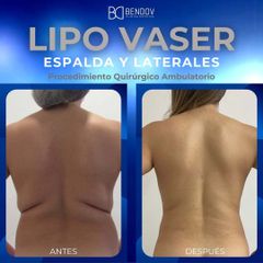 Lipo Vaser - Clinica Bendov