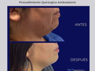 Liposucción antes y después - 872304