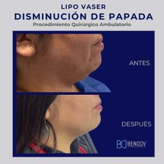 Lipo Vaser Disminución de Papada - Clinica Bendov