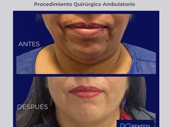 Liposucción antes y después - 872305