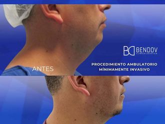 Liposucción antes y después - 872306