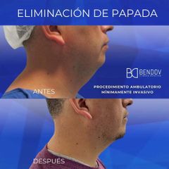 Eliminación de Papada - Clinica Bendov