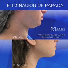 Eliminación de Papada - Clinica Bendov