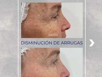 Bótox antes y después - 872308