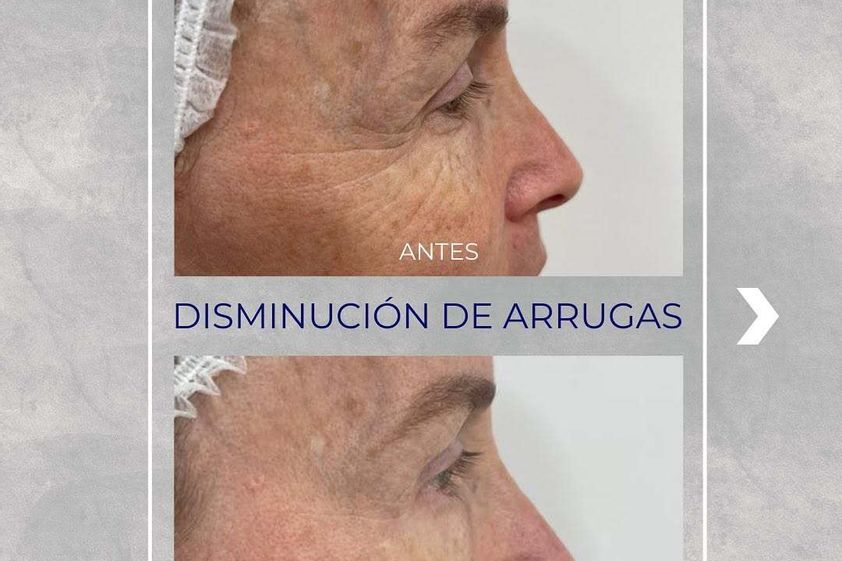 Bótox antes y después - 872308