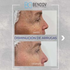 Botox - Clinica Bendov