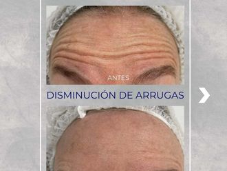 Bótox antes y después - 872309