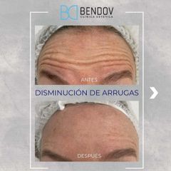 Botox - Clinica Bendov