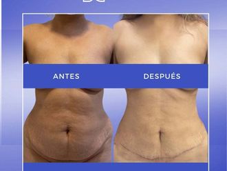 Liposucción antes y después - 872310