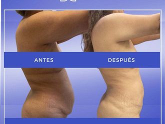 Liposucción antes y después - 872311