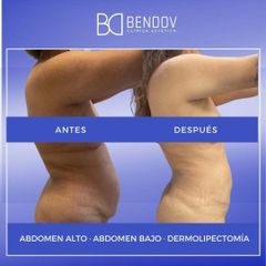 Lipo Vaser - Clinica Bendov