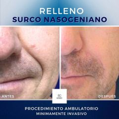 Relleno Surco Nasogeniano - Clinica Bendov