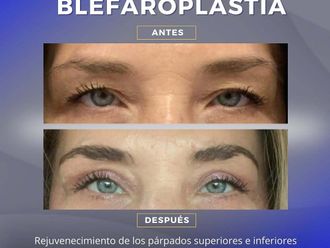 Blefaroplastía antes y después - 872313