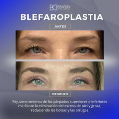 Blefaroplastia - Clinica Bendov