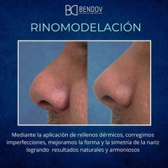 Rinomodelación - Clinica Bendov