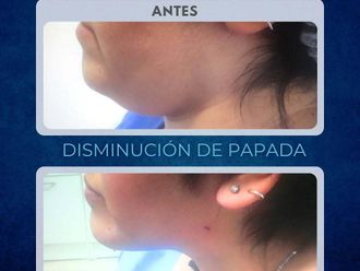 Liposucción antes y después - 872315